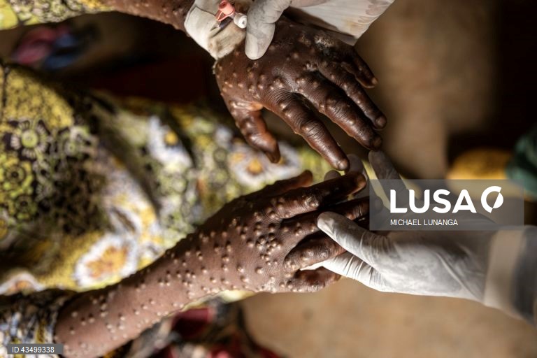 Moçambique sem casos de mpox após seis meses do anúncio do surto